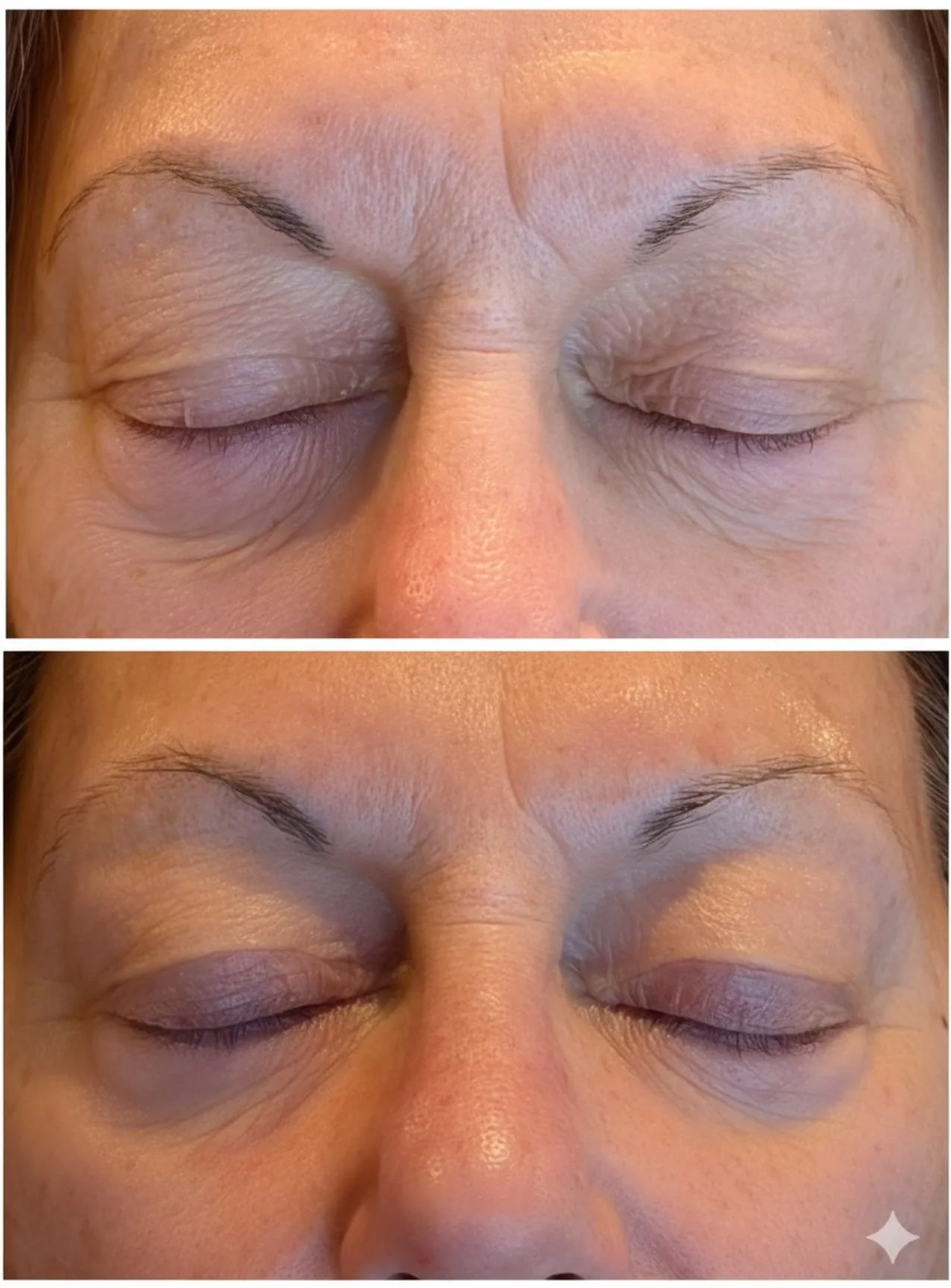 DENSITY RF Lifting Facial NYC | ANSO Med Spa
